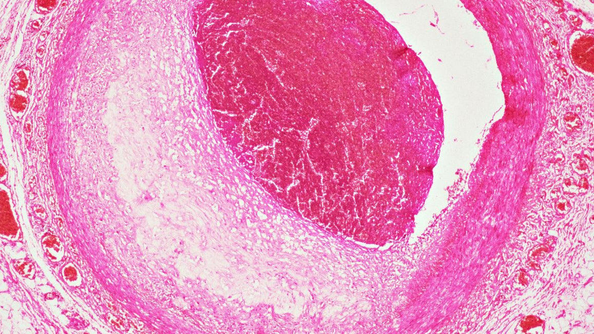 Preventing heartache: sugar intake and your cardiovascular health