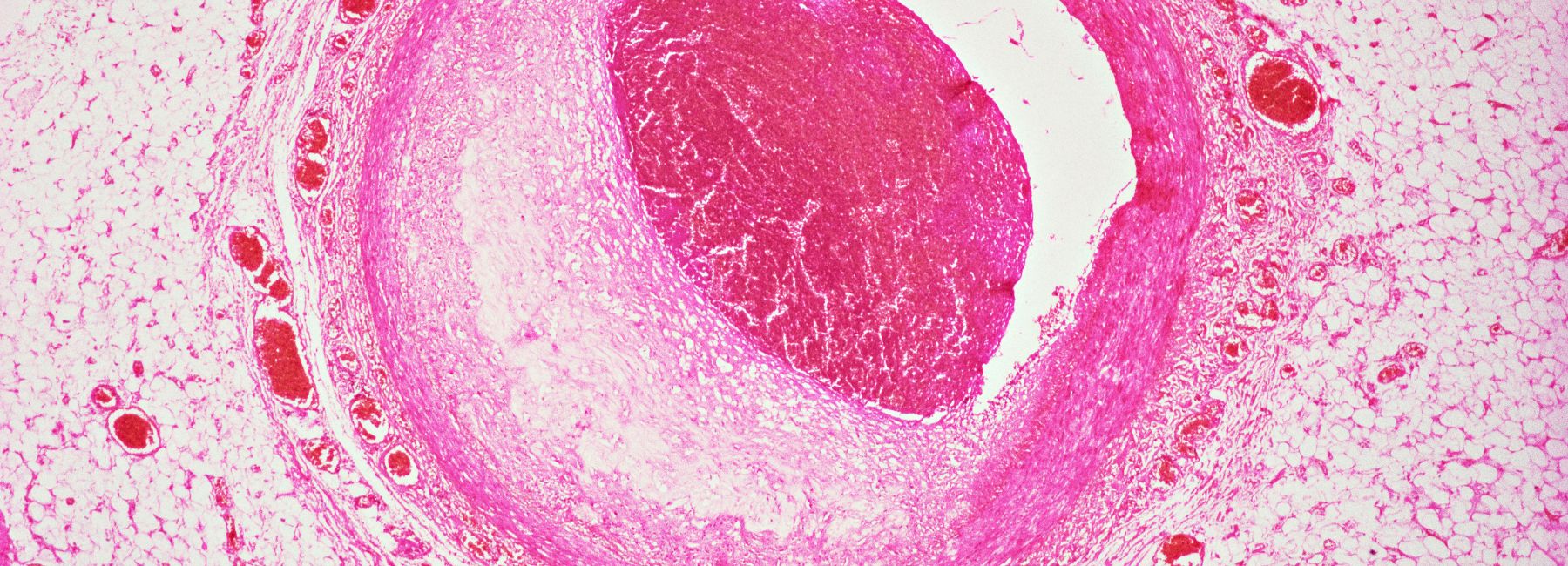 Preventing heartache: sugar intake and your cardiovascular health