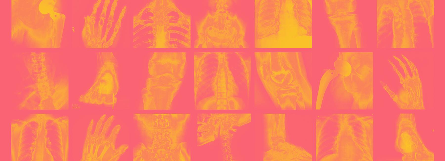 Arthritis and chronic inflammation: Finding relief with turmeric